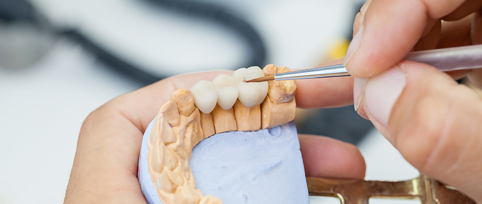 Kronen und Brücken bei Ihrem Zahnarzt in Castrop-Rauxel